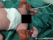 新生儿双腿透明惊呆医生 婴儿双腿像被剥去皮肤一样毛细血管清晰可见