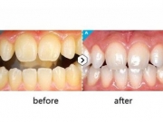 怎么美白牙齿健康又安全 献上最全的方法