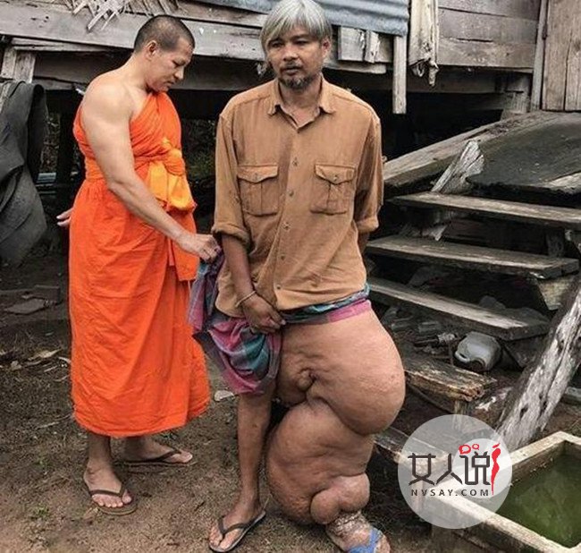 泰国男子长出象腿 因没钱久拖不治致腿部肿胀不堪好凄惨