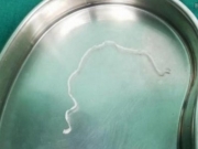 可怕！广东一医院从12岁女孩头部取出25厘米寄生虫
