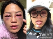香港女星蔡嘉燕录节目惨遭暴打 双眼瘀血成“猪头”