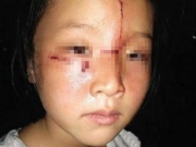 7岁女童遭陌生男划脸 在广州受伤害在广州受关爱