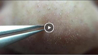 放大数倍画面拔鼻子粉刺过程秒拍视频 网友求镊子名字链接