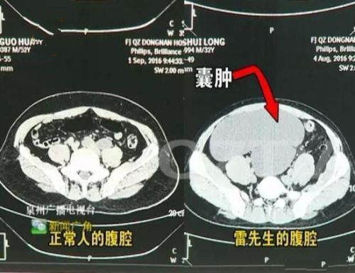 男子体内4个肾 是先天性的？还是后来变异的？