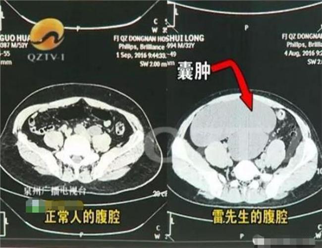 男子体内4个肾  不一样的4台iPhone