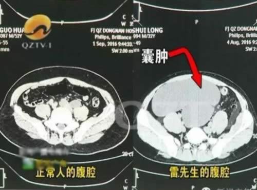 男子体内4个肾 这次赚大了但医生却告诉他