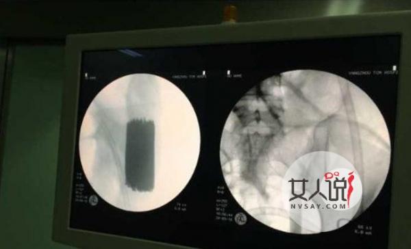 女子吞88根铁钉 女子生吞88根铁钉真相竟是这样令人傻眼