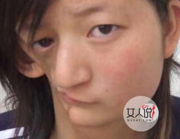 13岁少女患怪病 从小排不出便导致大便堆积腹中险爆炸