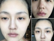 大S脖子怎么了 眼神暗淡无光脖子惊现淤血红印