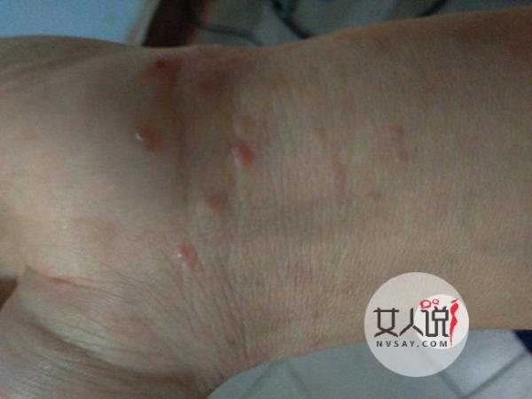 手上起泡痒怎么办 是季节性还是不注意卫生引起都应该这样