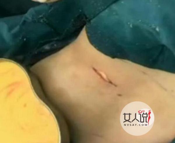 可怕！女子胸竟掉肚子上 隆胸后假体掉落到小腹惊现四胸