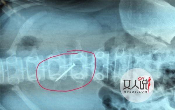女孩吞下4厘米铁钉 揭女孩被逼吞铁钉事件始末很惊悚