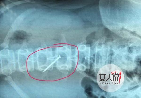 女孩吞4厘米铁钉 疑遭校园欺凌逼迫吞下生锈铁钉险丧命