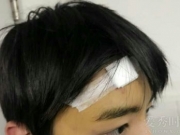 TFBOYS王俊凯杀青兴奋过度受伤 不慎撞门额头流血