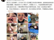女子丽江遭暴打致毁容 警方通报：已控制住嫌疑人