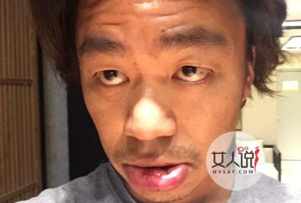 王宝强晒在病床上的照片 小腿骨折的来源竟是如此的悲凉