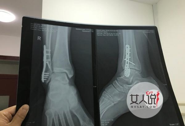 王宝强晒在病床上的照片 小腿骨折的来源竟是如此的悲凉