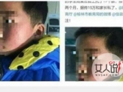 校长用笔扎学生脸 男孩脸上被扎得很恐怖照片曝光