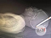 男子头遭人打进蚂蟥钉 画面血淋淋恐怖至极简直惨不忍睹