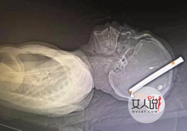 男子头遭人打进蚂蟥钉 画面血淋淋恐怖至极简直惨不忍睹