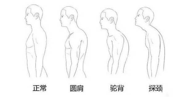 颈部前倾与驼背混为一谈