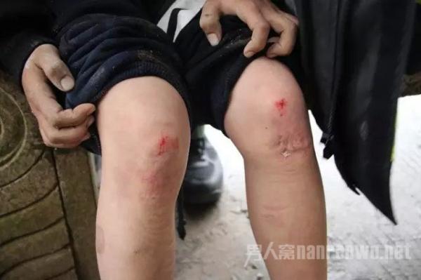 男孩被压伤的脚