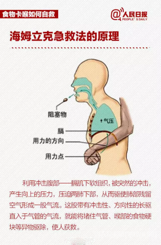 海姆立克急救法