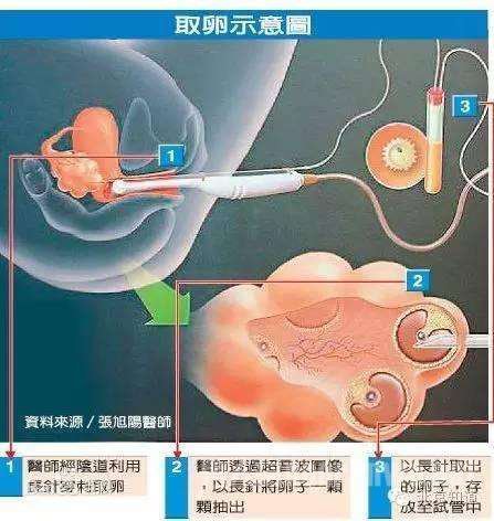 取卵示意图
