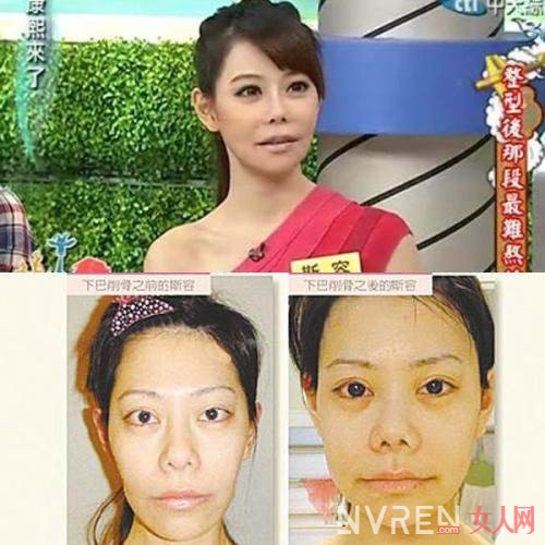 女星整形容貌走样 盘点整容失败的女星谁最惨