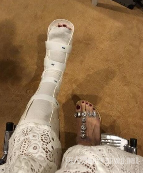 白百何左腿伤自嘲