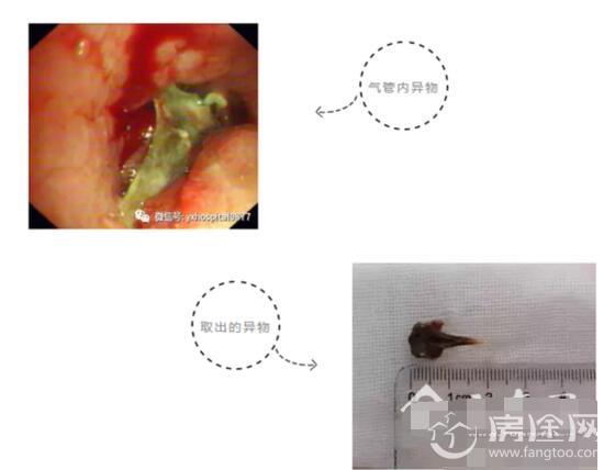 男子气管被鱼刺卡7年