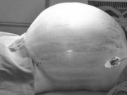 老太腹部隆起像怀三胞胎孕妇 手术取出34斤重肿瘤