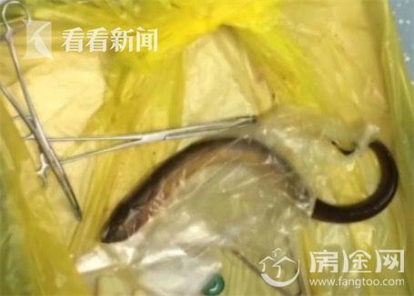 疑似黄鳝门好恐怖 黄鳝从肛门钻进肚子男子被送医不愿多谈事情经过