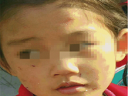 女孩遭生母虐打 满脸伤痕头发被扯掉一半