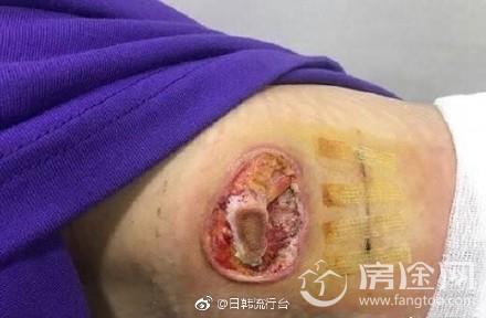 韩艺瑟公布最新伤口照片