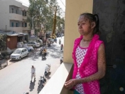 印13岁“蛇女”患鱼鳞病无法外出过正常生活